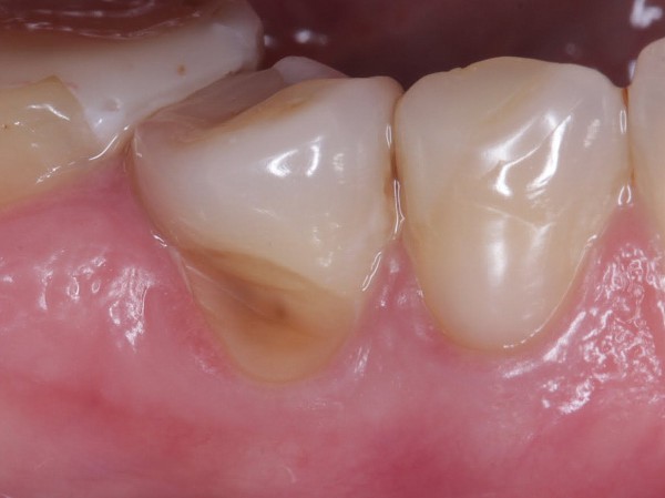 Клиновидный дефект